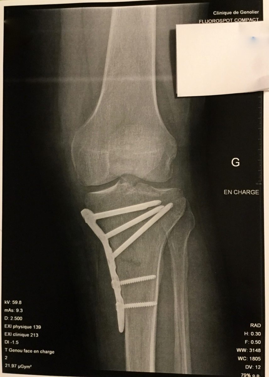 Tibia after 2 months of Reiki treatment