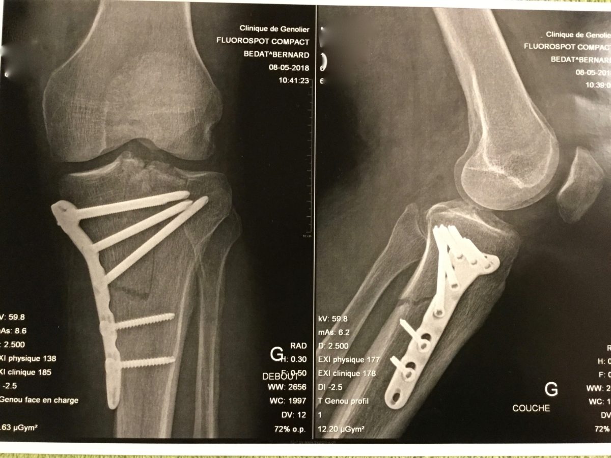 Tibia after surgery